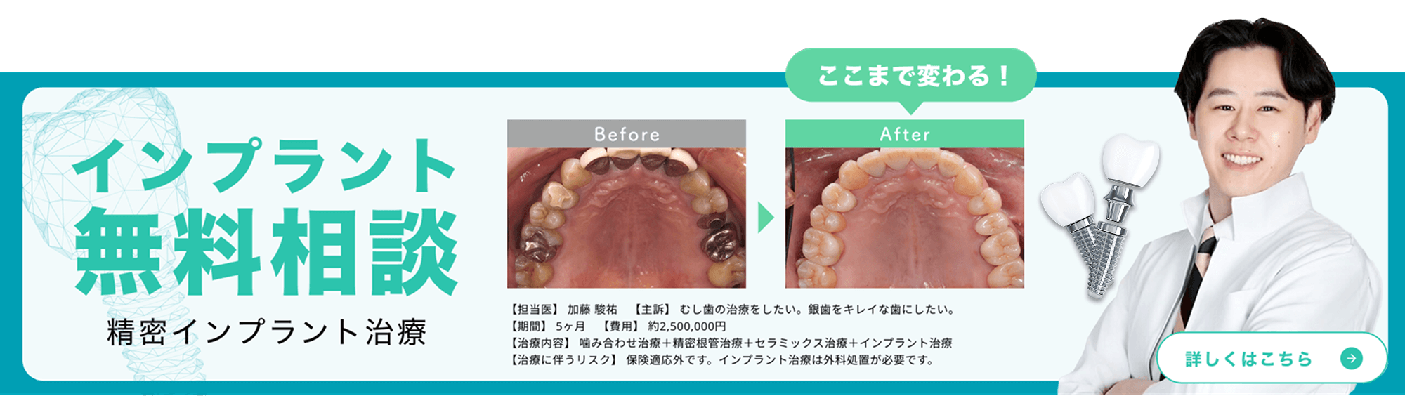 インプラント無料相談 精密インプラント治療 ここまで変わる！詳しくはこちら